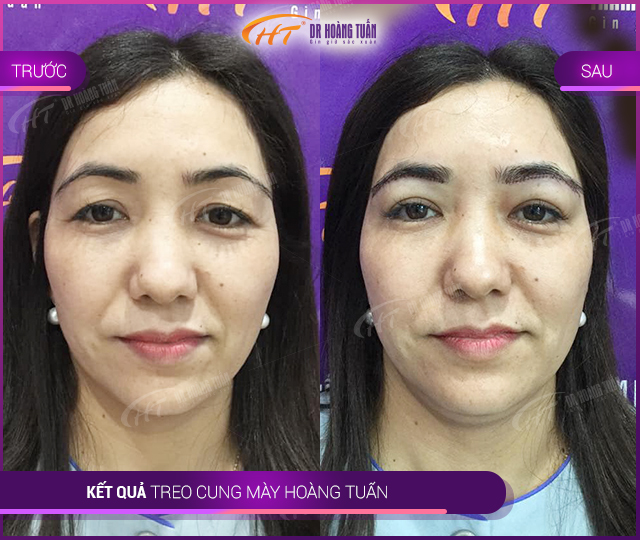 Kết quả nâng cung chân mày tại Thẩm mỹ Hoàng Tuấn